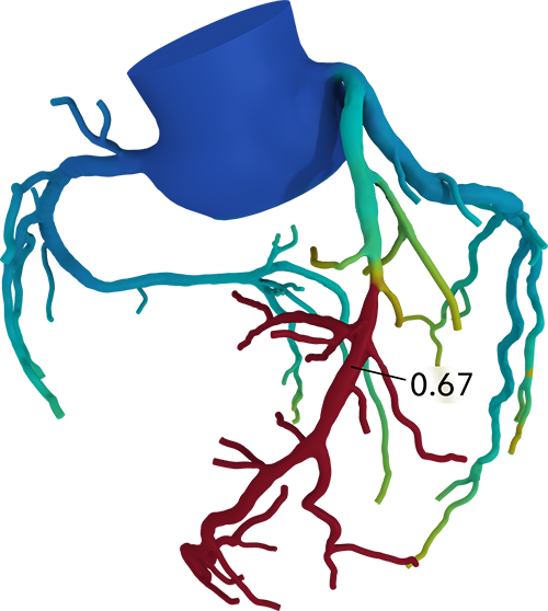 HeartFlow 3D Color Coded Model